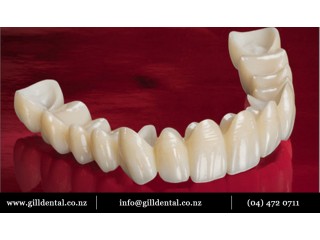 Dental Bridge
