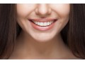 teeth-cleaning-and-scaling-springvale-dental-small-1