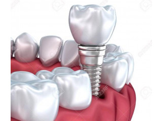 Affordable Dental Implants Cost in Sydney - Dr Paulo Pinho