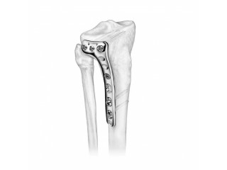 Experienced Orthopedic Device Manufacturers