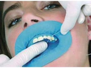 Retain Your Oral Aesthetics and Functionality at the Best Tooth Capping Cost