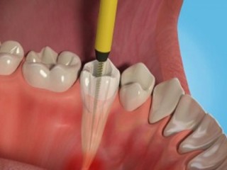 Retain Your Oral Health by Opting for Pain-free Root Canal Treatment in Delhi