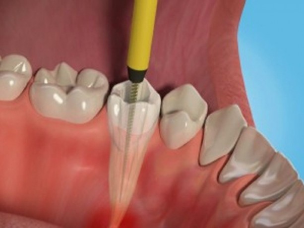 retain-your-oral-health-by-opting-for-pain-free-root-canal-treatment-in-delhi-big-0