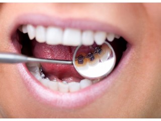 DR. C Family Dentistry | Clear Braces for Adults
